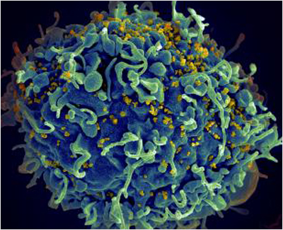 Hiv Enfeksiyonu (Hastalığı)